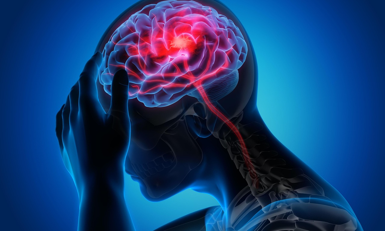 migraine